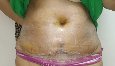 Abdominoplasty After