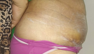 Abdominoplasty After