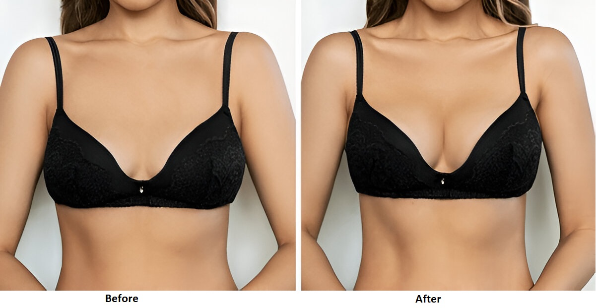 breast augmentation Before and After
