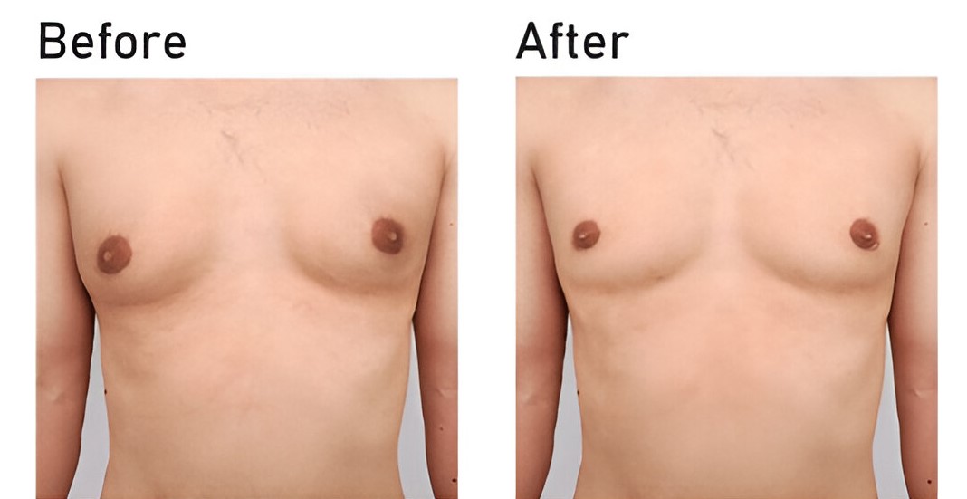 Before and After male Breast Reduction Surgery