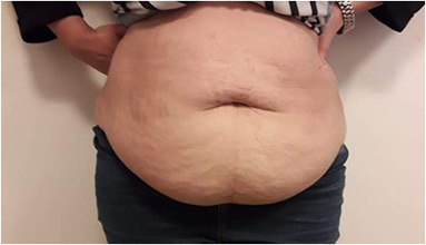 Abdominoplasty Before