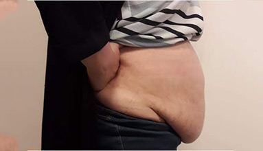 Abdominoplasty Before