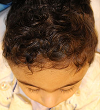 Craniofacial Surgery After