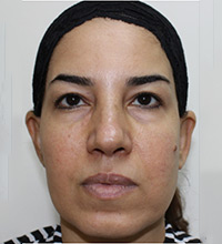 Facelift Before