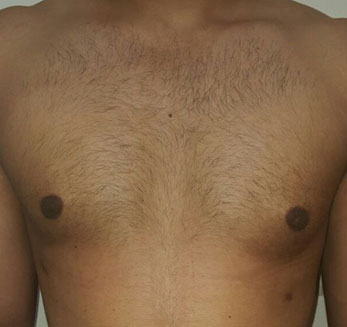 Gynecomastia Treatment After