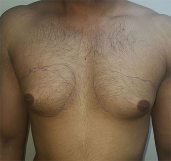 Gynecomastia Treatment Before