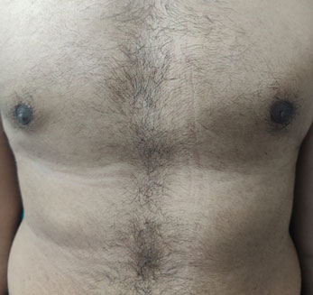 Gynecomastia Treatment After