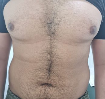 Gynecomastia Treatment Before