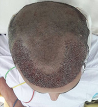 Hair Transplant After