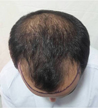 Hair Transplant Before