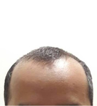 Hair Transplant Before