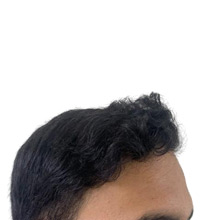 Hair Transplant After