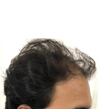 Hair Transplant Before