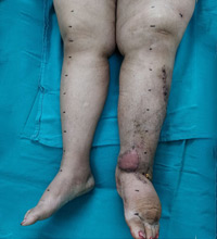 Lymphedema After