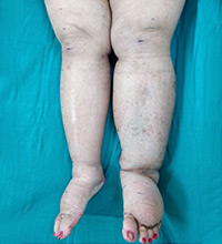 Lymphedema Before