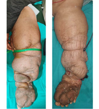 Lymphedema After