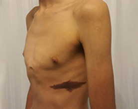 Pectus Correction Before