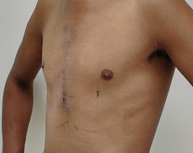 Pectus Correction After