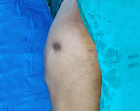 Pectus Correction After