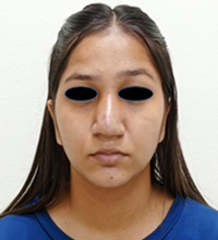 Rhinoplasty After